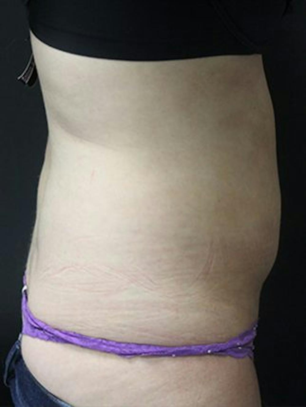 Emsculpt Neo Before & After Gallery - Patient 25139625 - Image 2