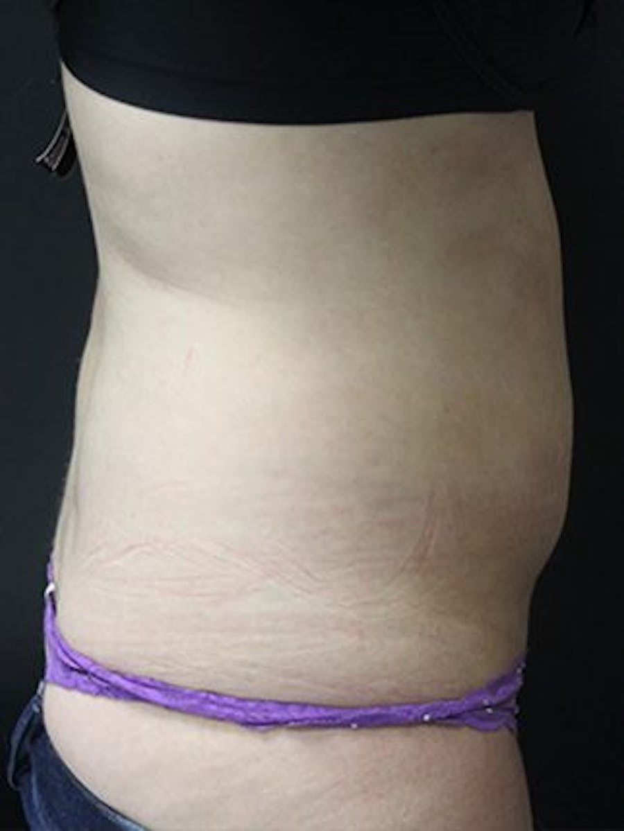 Emsculpt Neo Before & After Gallery - Patient 25139625 - Image 2
