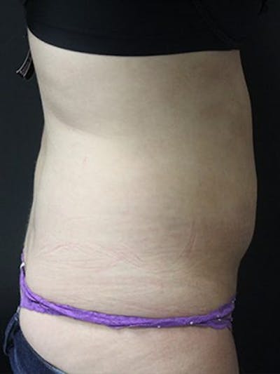Emsculpt Before & After Gallery - Patient 25139625 - Image 2