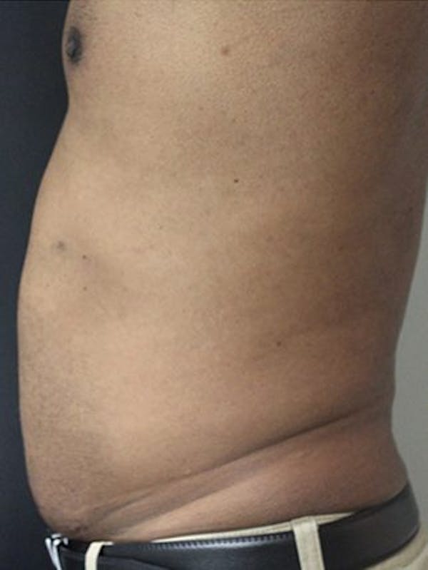 Emsculpt Neo Before & After Gallery - Patient 25139632 - Image 1