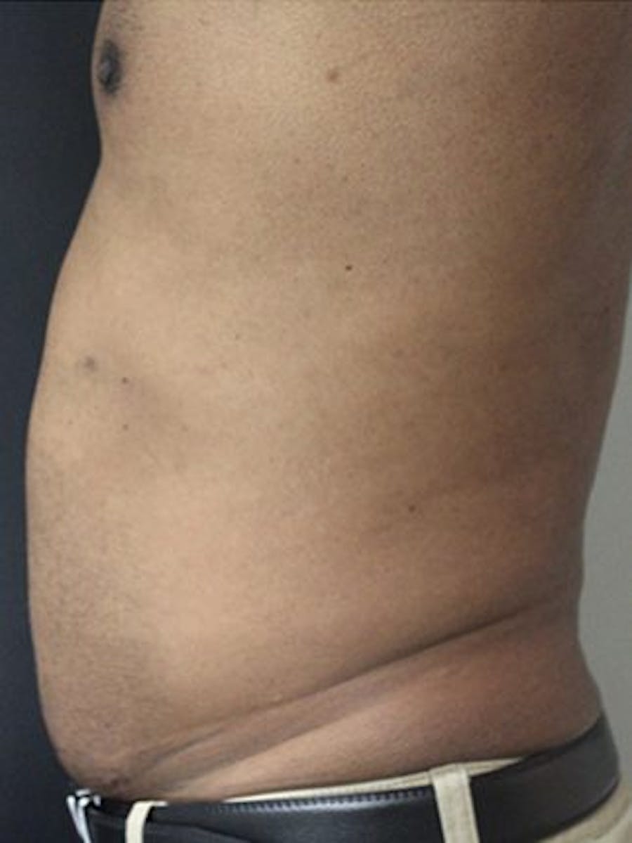 Emsculpt Neo Before & After Gallery - Patient 25139632 - Image 1