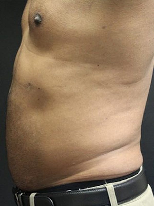 Emsculpt Neo Before & After Gallery - Patient 25139632 - Image 2