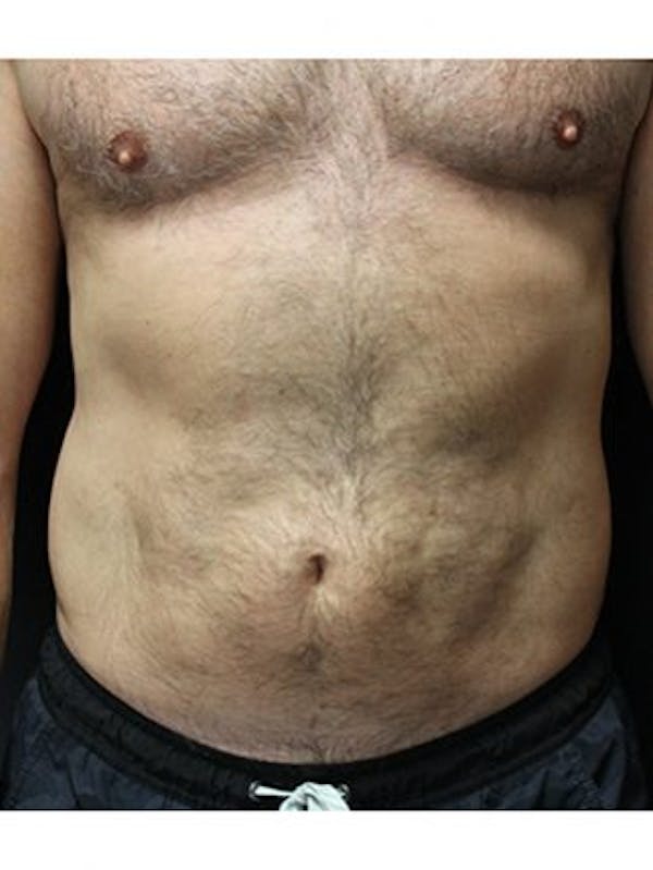 Emsculpt Neo Before & After Gallery - Patient 25139633 - Image 2
