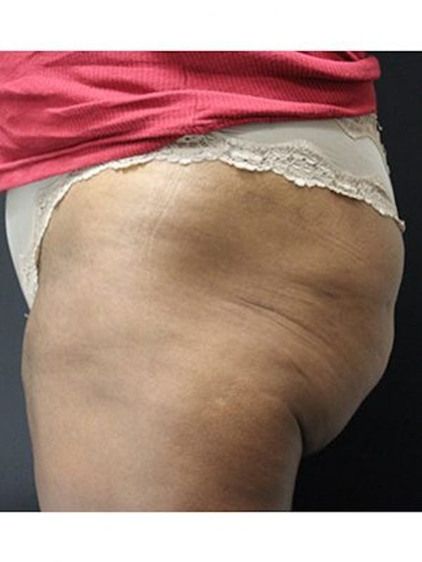 Emsculpt Neo Before & After Gallery - Patient 25139634 - Image 1