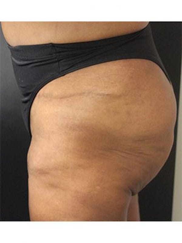Emsculpt Neo Before & After Gallery - Patient 25139634 - Image 2