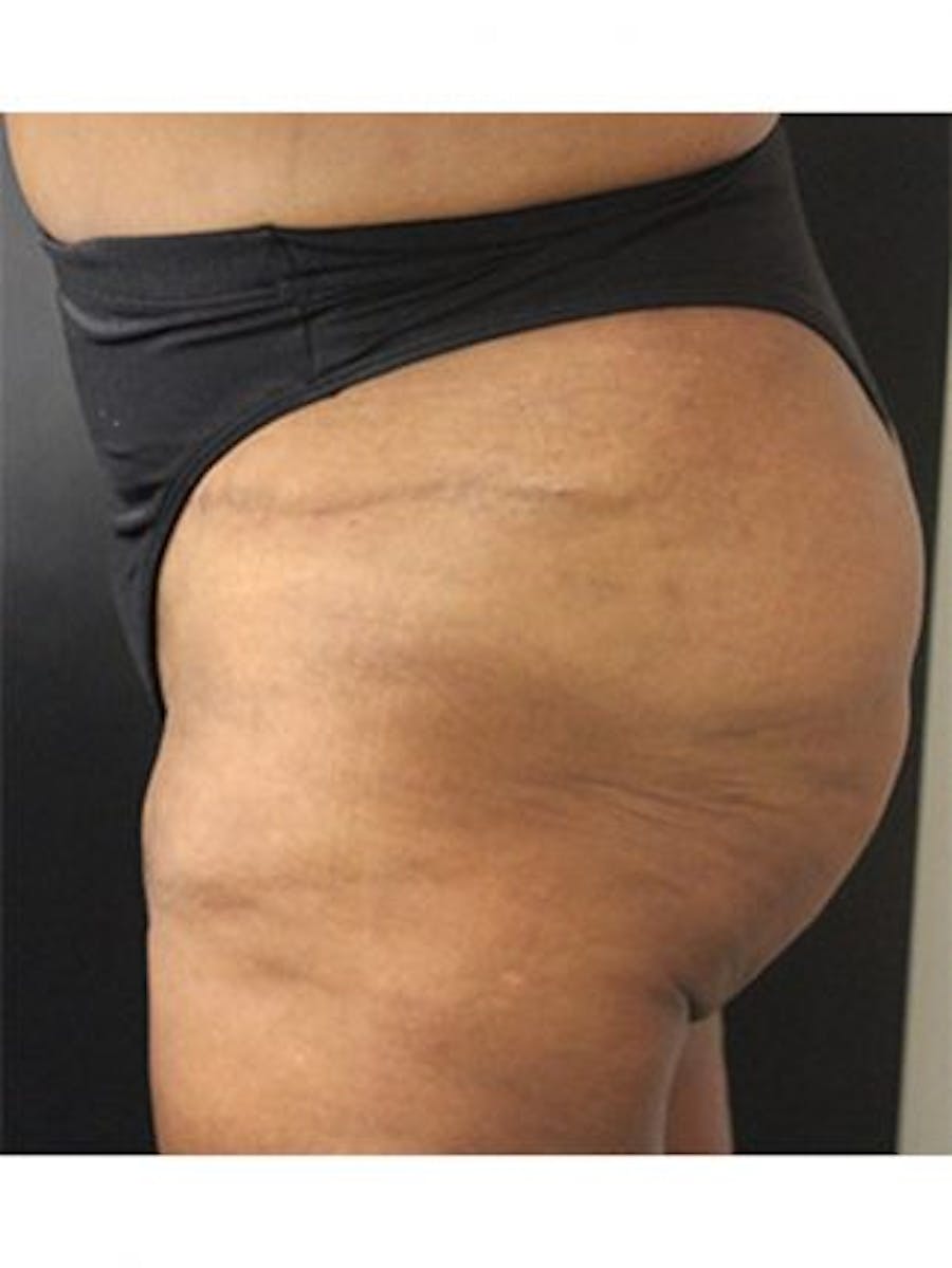 Emsculpt Neo Before & After Gallery - Patient 25139634 - Image 2