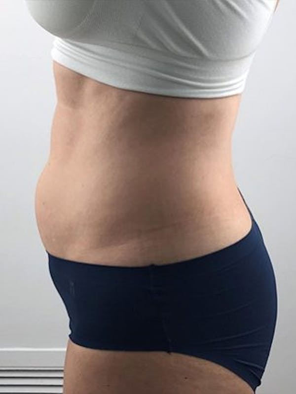 Emsculpt Neo Before & After Gallery - Patient 25139636 - Image 1