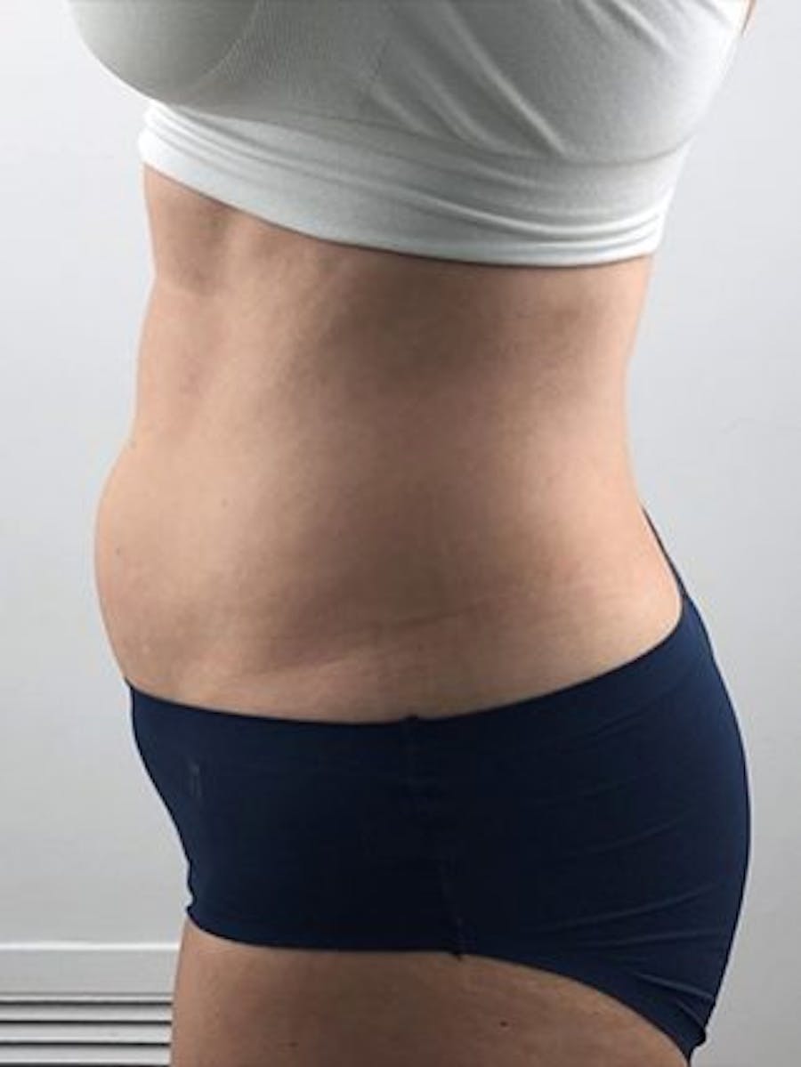 Emsculpt Neo Before & After Gallery - Patient 25139636 - Image 1
