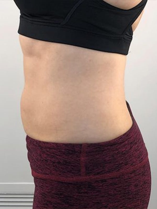 Emsculpt Neo Before & After Gallery - Patient 25139636 - Image 2