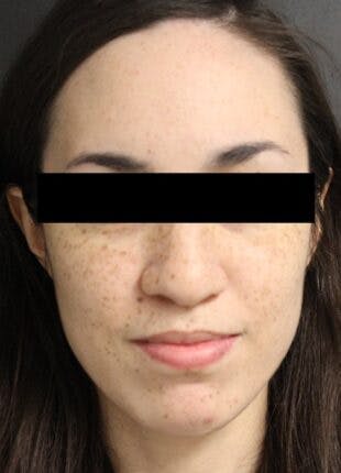 Rhinoplasty