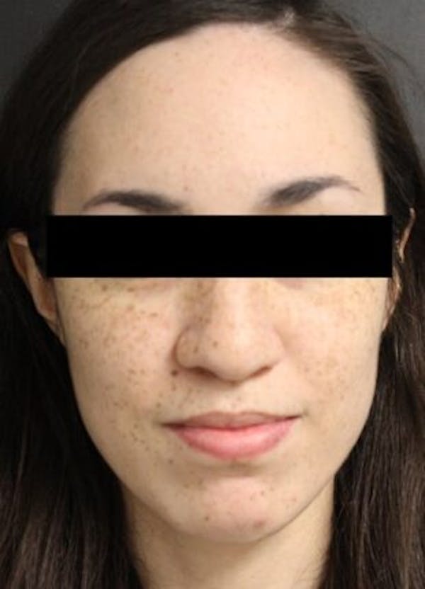Rhinoplasty Before & After Gallery - Patient 25139667 - Image 1