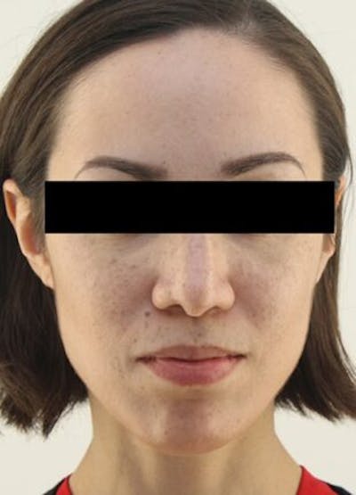 Before & After Rhinoplasty in NYC