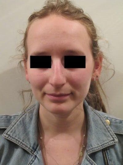 Rhinoplasty Before & After Gallery - Patient 25139669 - Image 1