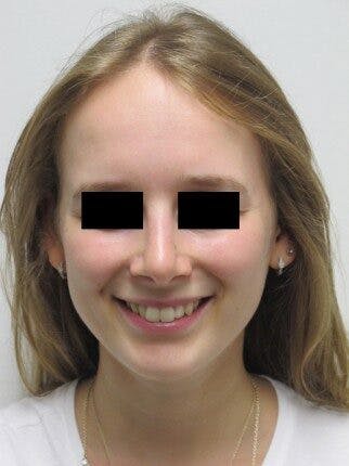 Rhinoplasty