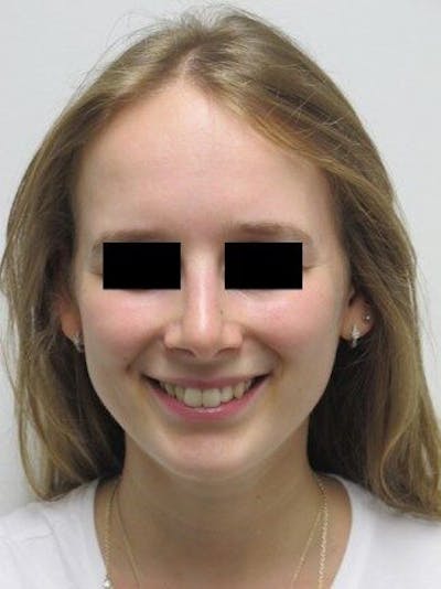 Rhinoplasty Before & After Gallery - Patient 25139669 - Image 2