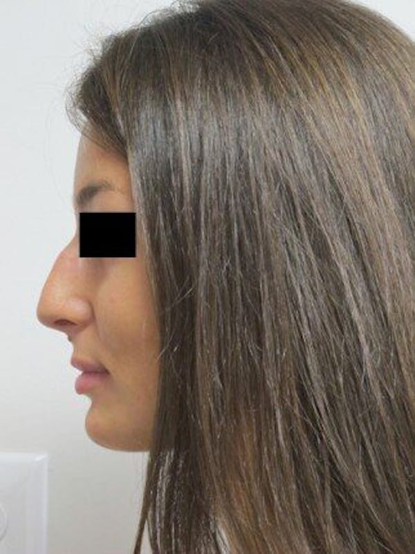 Rhinoplasty Before & After Gallery - Patient 25139670 - Image 1