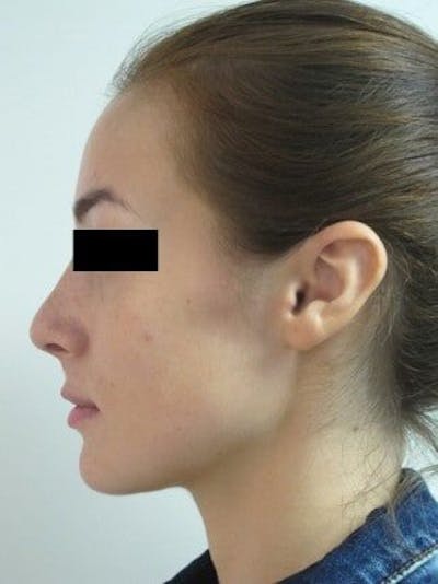 Rhinoplasty Before & After Gallery - Patient 25139670 - Image 2