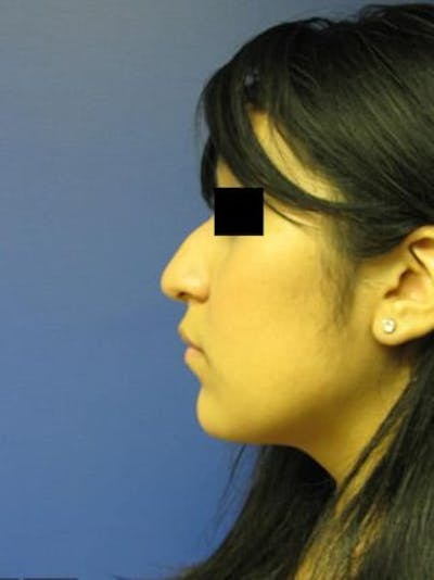 Rhinoplasty Before & After Gallery - Patient 25139672 - Image 1