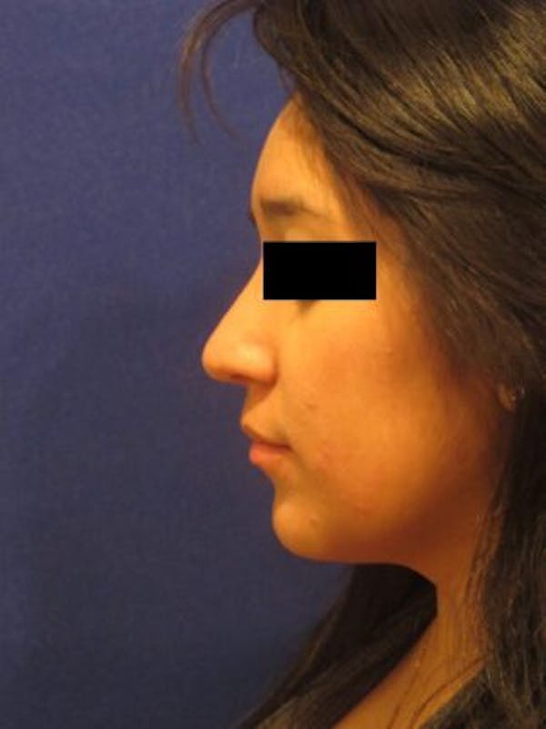 Rhinoplasty Before & After Gallery - Patient 25139672 - Image 2