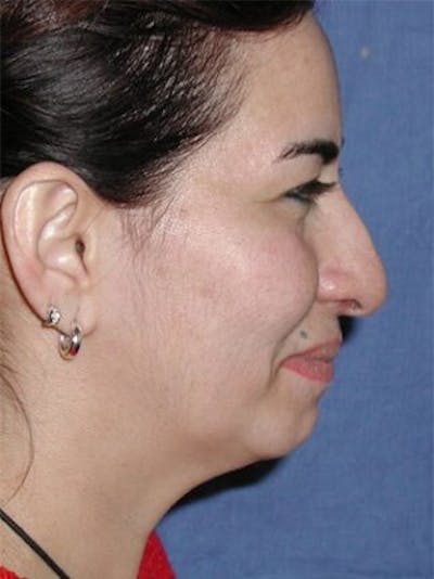 Rhinoplasty Before & After Gallery - Patient 25139673 - Image 1