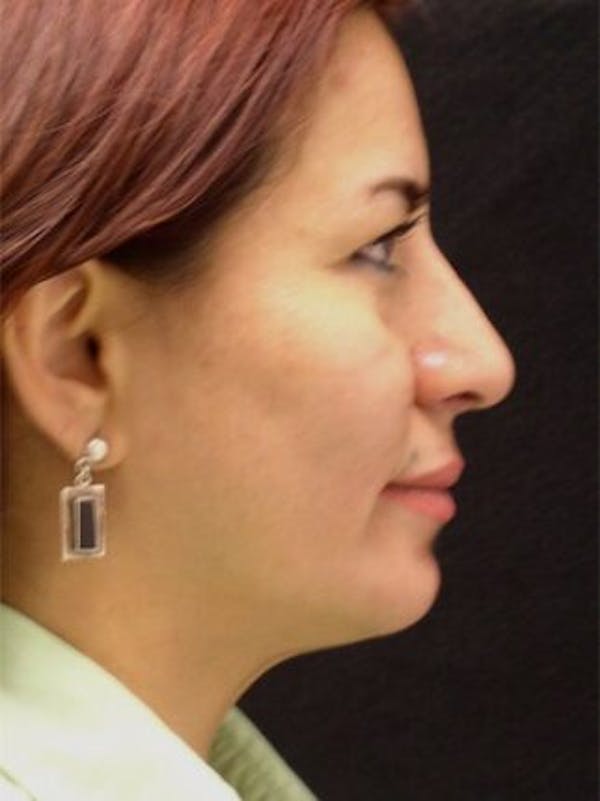 Rhinoplasty Before & After Gallery - Patient 25139673 - Image 2