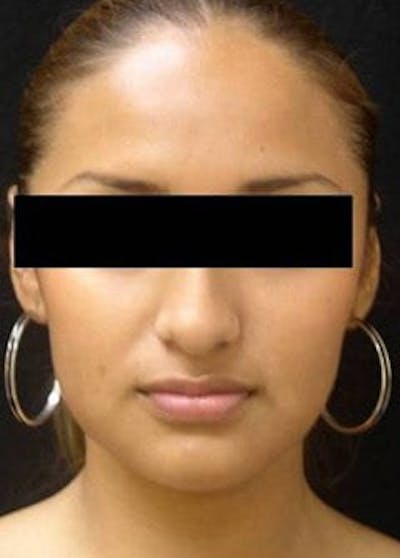 Rhinoplasty Before & After Gallery - Patient 25139674 - Image 1