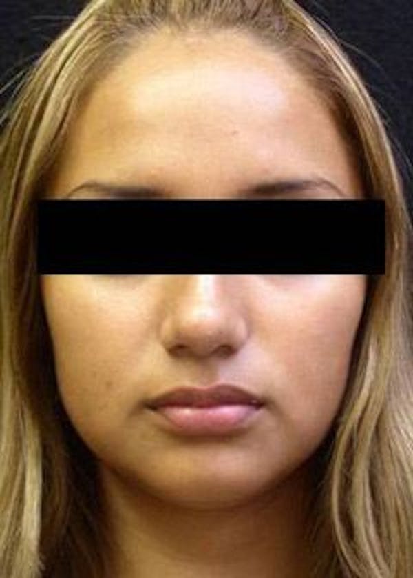 Rhinoplasty Before & After Gallery - Patient 25139674 - Image 2
