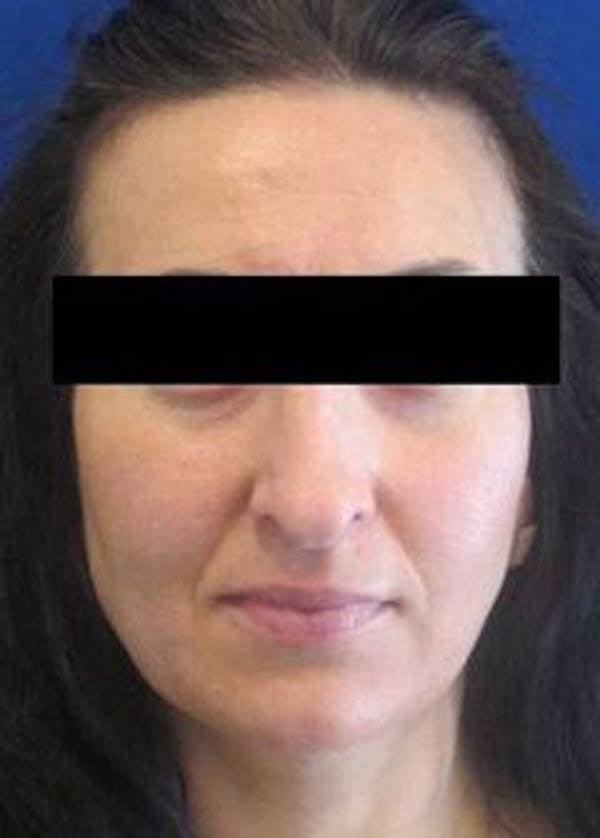 Rhinoplasty Before & After Gallery - Patient 25139676 - Image 1