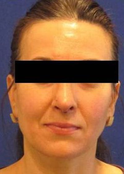 Before & After Rhinoplasty in Westchester, New York