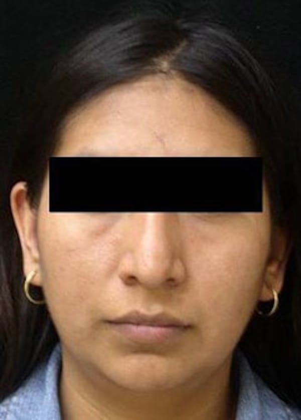 Rhinoplasty Before & After Gallery - Patient 25139692 - Image 1
