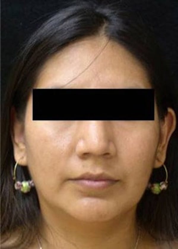 Rhinoplasty Before & After Gallery - Patient 25139692 - Image 2