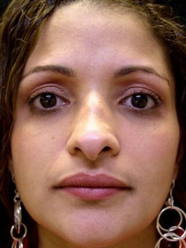 Rhinoplasty Before & After Gallery - Patient 25139706 - Image 1