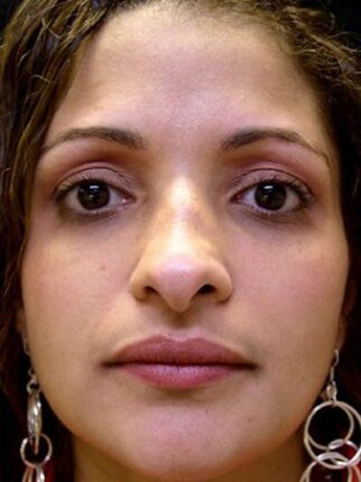 Rhinoplasty Before & After Gallery - Patient 25139706 - Image 1