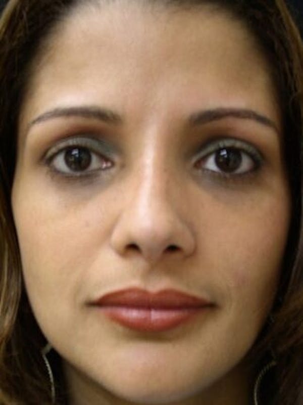 Rhinoplasty Before & After Gallery - Patient 25139706 - Image 2