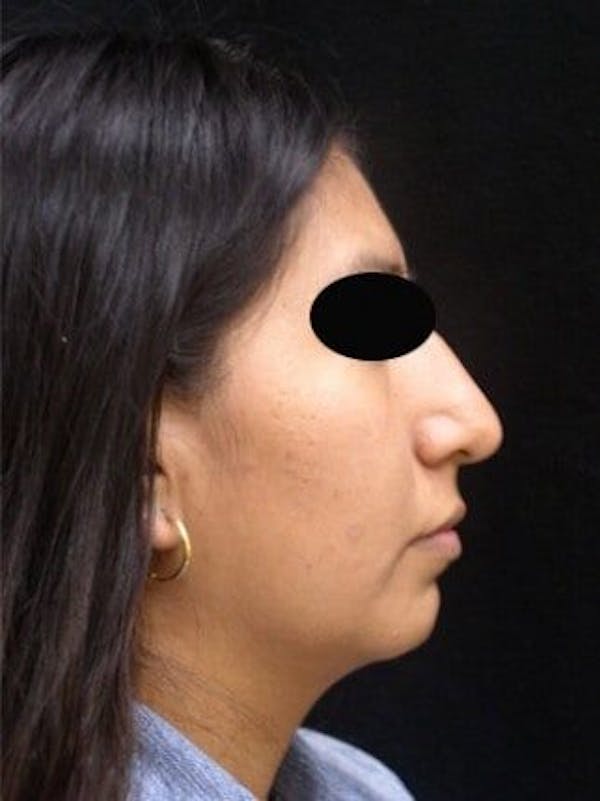 Rhinoplasty Before & After Gallery - Patient 25139708 - Image 1