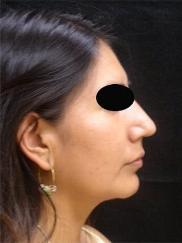 Rhinoplasty Before & After Gallery - Patient 25139708 - Image 2
