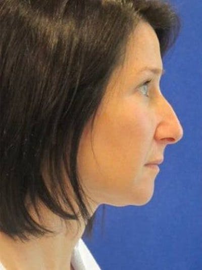 Rhinoplasty Before & After Gallery - Patient 25139731 - Image 1