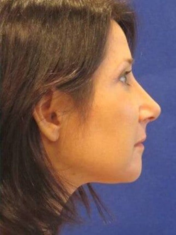 Rhinoplasty Before & After Gallery - Patient 25139731 - Image 2