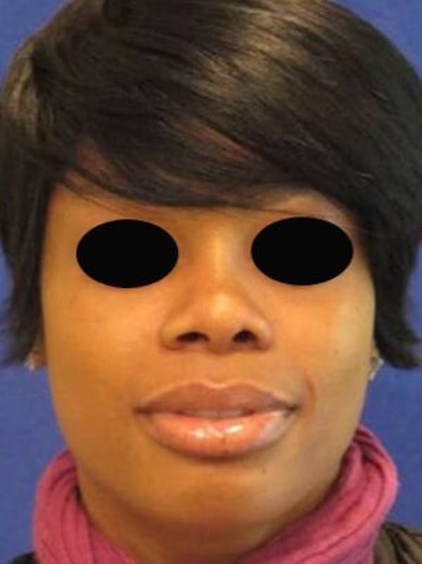 Rhinoplasty Before & After Gallery - Patient 25139734 - Image 2