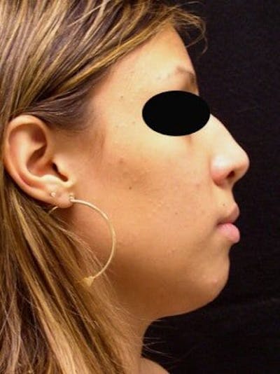 Rhinoplasty Before & After Gallery - Patient 25139757 - Image 1