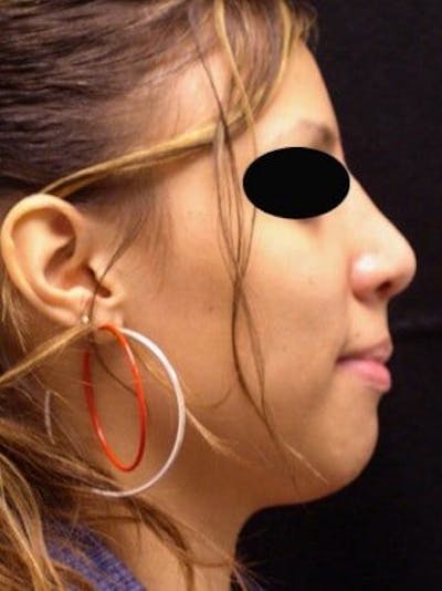 Rhinoplasty Before & After Gallery - Patient 25139757 - Image 2