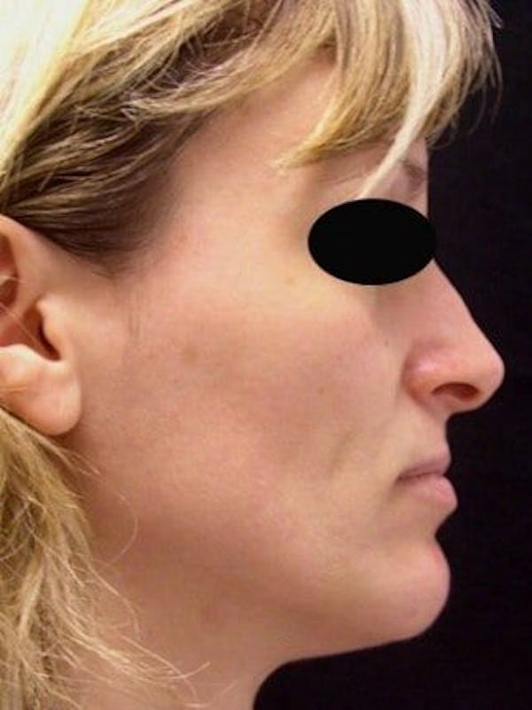 Rhinoplasty Before & After Gallery - Patient 25139777 - Image 1