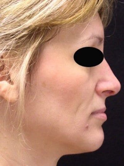 Rhinoplasty Before & After Gallery - Patient 25139777 - Image 2