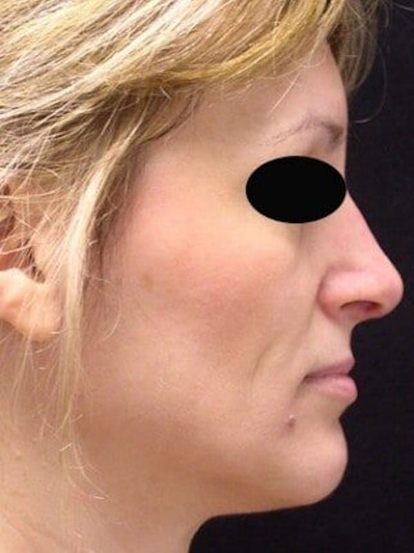 Rhinoplasty Before & After Gallery - Patient 25139777 - Image 2