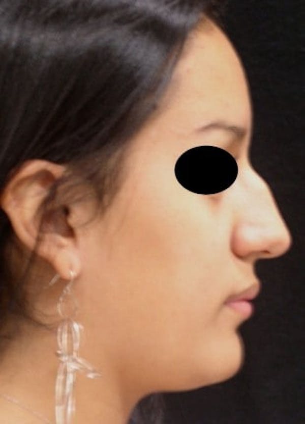 Rhinoplasty Before & After Gallery - Patient 25139788 - Image 1