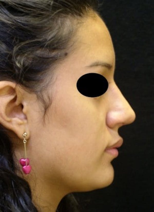 Rhinoplasty Before & After Gallery - Patient 25139788 - Image 2