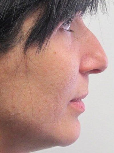 Rhinoplasty Before & After Gallery - Patient 25139789 - Image 1