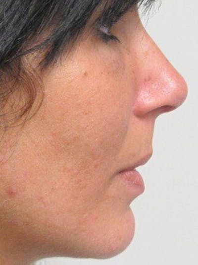 Rhinoplasty Before & After Gallery - Patient 25139789 - Image 2