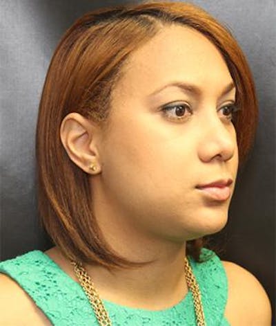 Rhinoplasty Before & After Gallery - Patient 25139796 - Image 2