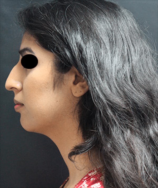 Rhinoplasty Before & After Gallery - Patient 25139804 - Image 1